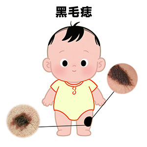 <strong>黑毛痣从小就有而且没有变大，是不是可以一直不管它？</strong>