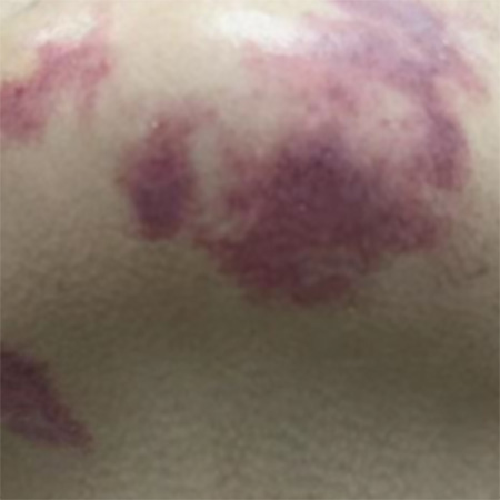 南京胎记医生排名榜：女生脚底有红色胎记是什么意思？